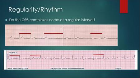 Regularity/Rhythm Do the QRS complexes come at a regular interval?