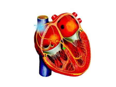 Right Bundle Branch Block