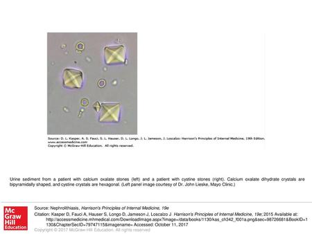 Urine sediment from a patient with calcium oxalate stones (left) and a patient with cystine stones (right). Calcium oxalate dihydrate crystals are bipyramidally.