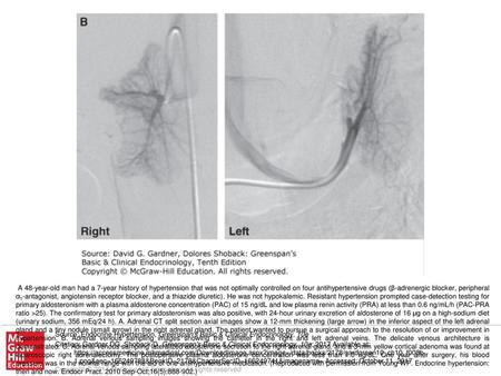 A 48-year-old man had a 7-year history of hypertension that was not optimally controlled on four antihypertensive drugs (β-adrenergic blocker, peripheral.