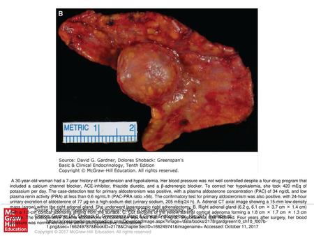 A 30-year-old woman had a 7-year history of hypertension and hypokalemia. Her blood pressure was not well controlled despite a four-drug program that included.