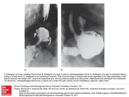 A. Radiogram of a type I (sliding) hiatal hernia. B