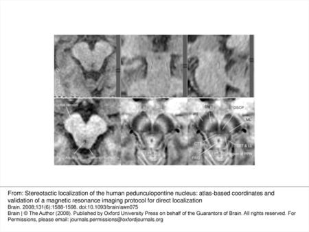 Fig. 4 A (top row): T1 weighted MR images from planning software showing atlas-based localization of PPN: axial, coronal and sagittal. The axial section.