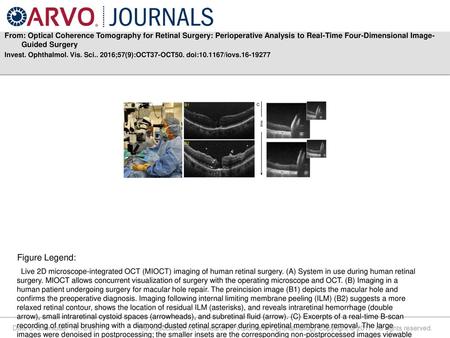 From: Optical Coherence Tomography for Retinal Surgery: Perioperative Analysis to Real-Time Four-Dimensional Image-Guided Surgery Invest. Ophthalmol. Vis.