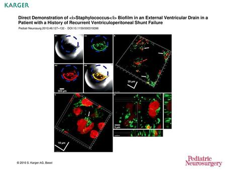 Direct Demonstration of Staphylococcus Biofilm in an External Ventricular Drain in a Patient with a History of Recurrent Ventriculoperitoneal Shunt.