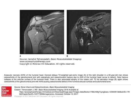 Avascular necrosis (AVN) of the humeral head