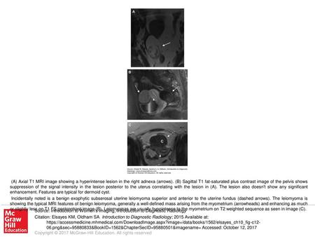 Incidentally noted is a benign exophytic subserosal uterine leiomyoma superior and anterior to the uterine fundus (dashed arrows). The leiomyoma is showing.