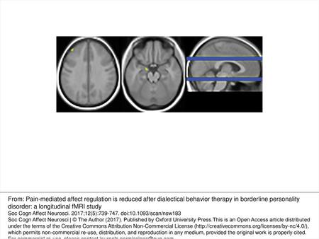 Fig. 1. Significant clusters in the amygdala and dlPFC, four-way interaction effect (group by valence by temperature by time), small volume corrected.