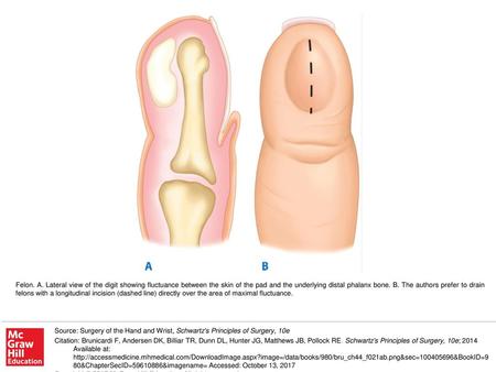 Felon. A. Lateral view of the digit showing fluctuance between the skin of the pad and the underlying distal phalanx bone. B. The authors prefer to drain.