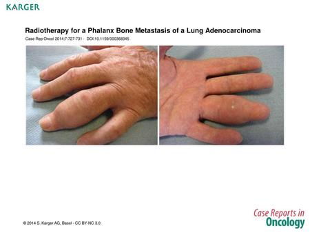 Radiotherapy for a Phalanx Bone Metastasis of a Lung Adenocarcinoma