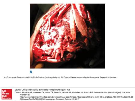 A. Open grade 3 comminuted tibia-fibula fracture (motorcycle injury). B. External fixator temporarily stabilizes grade 3 open tibia fracture. Source: Orthopedic.