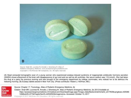 (A) Head computed tomographic scan of a young woman who experienced ecstasy-induced syndrome of inappropriate antidiuretic hormone secretion (SIADH) shows.