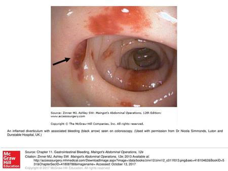 An inflamed diverticulum with associated bleeding (black arrow) seen on colonoscopy. (Used with permission from Dr Nicola Simmonds, Luton and Dunstable.