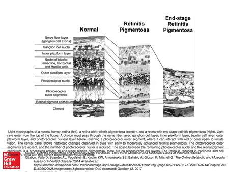 Light micrographs of a normal human retina (left), a retina with retinitis pigmentosa (center), and a retina with end-stage retinitis pigmentosa (right).