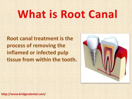 What is Root Canal Root canal treatment is the process of removing the inflamed or infected pulp tissue from within the tooth. http://www.bridgesdental.com/