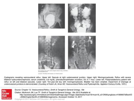 Cystograms revealing vesicoureteral reflux