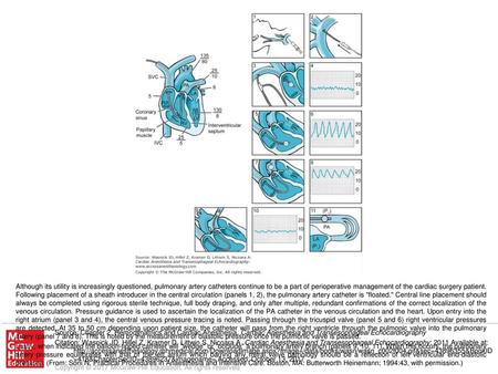 Lastly, when indicated the balloon-tipped catheter will wedge or occlude a pulmonary artery branch (panels 9, 10, 11). When this occurs, the pulmonary.