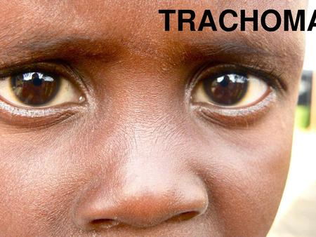 TRACHOMA.