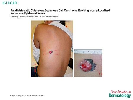 Fatal Metastatic Cutaneous Squamous Cell Carcinoma Evolving from a Localized Verrucous Epidermal Nevus Case Rep Dermatol 2013;5:272-282 - DOI:10.1159/000355605.