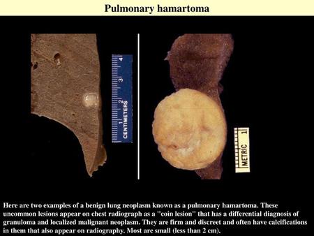 Pulmonary hamartoma Here are two examples of a benign lung neoplasm known as a pulmonary hamartoma. These uncommon lesions appear on chest radiograph as.