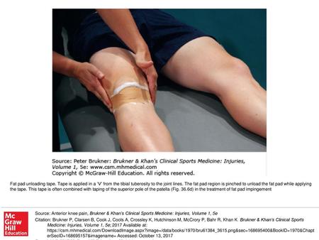 Fat pad unloading tape. Tape is applied in a ‘V’ from the tibial tuberosity to the joint lines. The fat pad region is pinched to unload the fat pad while.