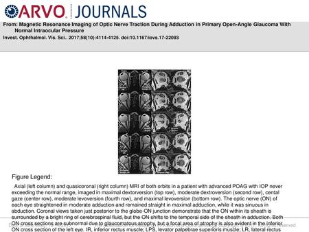 From: Magnetic Resonance Imaging of Optic Nerve Traction During Adduction in Primary Open-Angle Glaucoma With Normal Intraocular Pressure Invest. Ophthalmol.