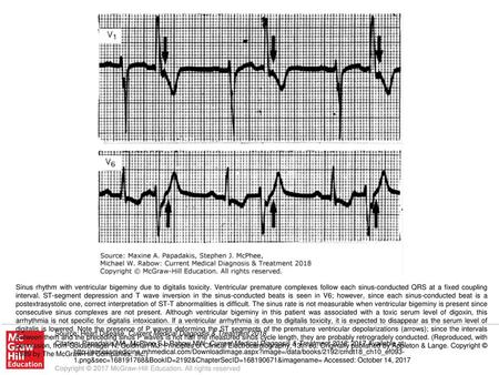 Sinus rhythm with ventricular bigeminy due to digitalis toxicity