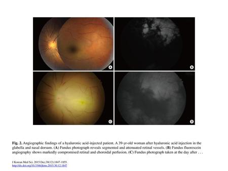 Fig. 2. Angiographic findings of a hyaluronic acid-injected patient