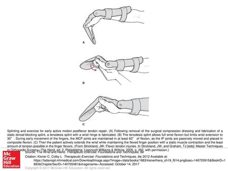 Splinting and exercise for early active motion postflexor tendon repair. (A) Following removal of the surgical compression dressing and fabrication of.