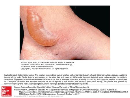 Acute allergic phytodermatitis, bullous This eruption occurred in a patient who had walked barefoot through a forest. It later spread as a papular eruption.