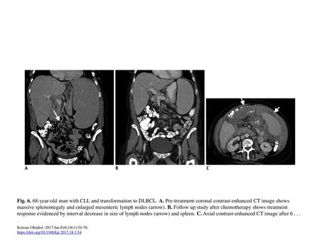 Fig year-old man with CLL and transformation to DLBCL. A