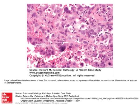 Large cell undifferentiated carcinoma of lung