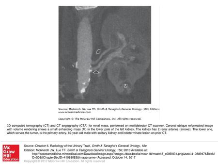 3D computed tomography (CT) and CT angiography (CTA) for renal mass, performed on multidetector CT scanner. Coronal oblique reformatted image with volume.