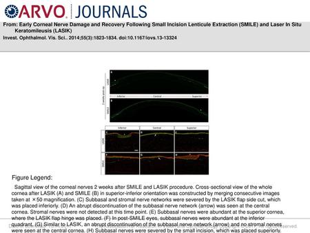 From: Early Corneal Nerve Damage and Recovery Following Small Incision Lenticule Extraction (SMILE) and Laser In Situ Keratomileusis (LASIK) Invest. Ophthalmol.