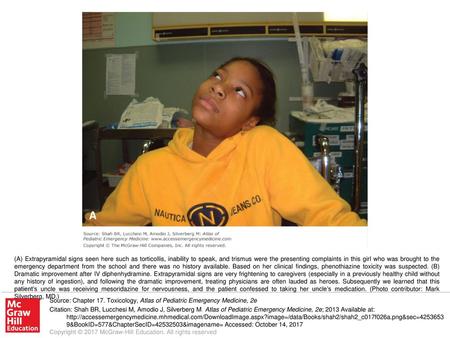 (A) Extrapyramidal signs seen here such as torticollis, inability to speak, and trismus were the presenting complaints in this girl who was brought to.