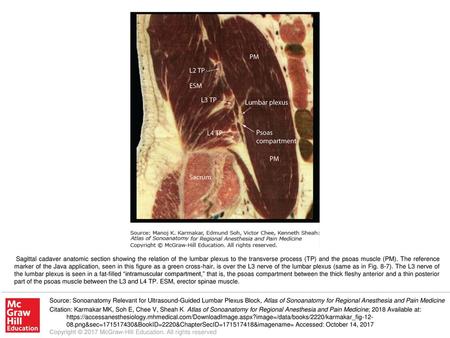 Sagittal cadaver anatomic section showing the relation of the lumbar plexus to the transverse process (TP) and the psoas muscle (PM). The reference marker.