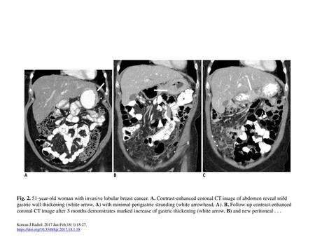 Fig year-old woman with invasive lobular breast cancer. A