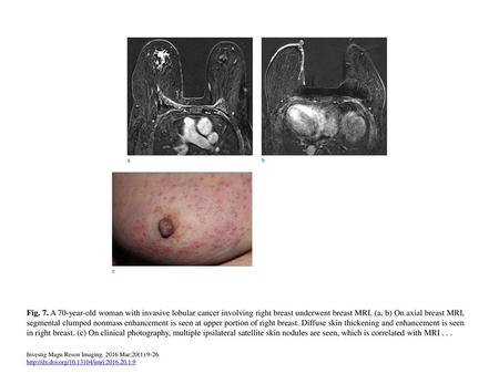 Fig. 7. A 70-year-old woman with invasive lobular cancer involving right breast underwent breast MRI. (a, b) On axial breast MRI, segmental clumped nonmass.