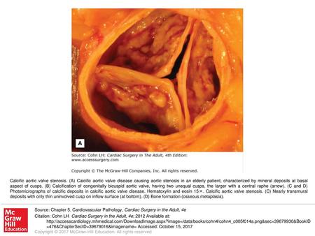 Calcific aortic valve stenosis