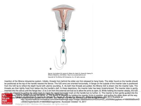 Insertion of the Mirena intrauterine system