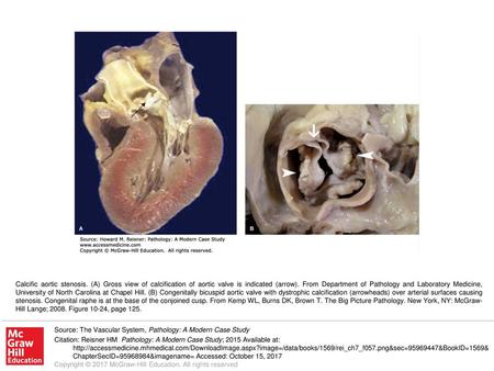 Calcific aortic stenosis