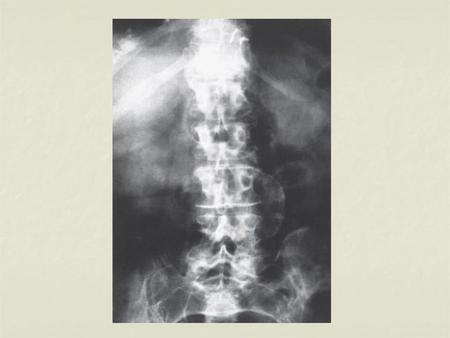 Notice anything? Calcified infrarenal aortic aneurysm – posterior view.