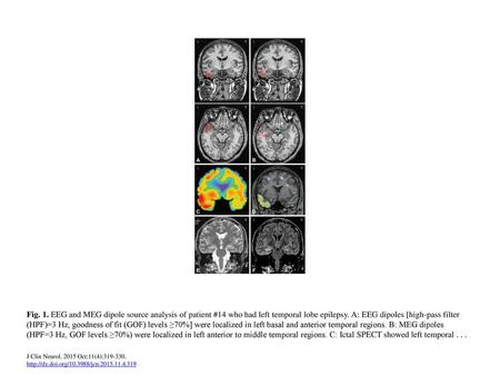 Fig. 1. EEG and MEG dipole source analysis of patient #14 who had left temporal lobe epilepsy. A: EEG dipoles [high-pass filter (HPF)=3 Hz, goodness of.