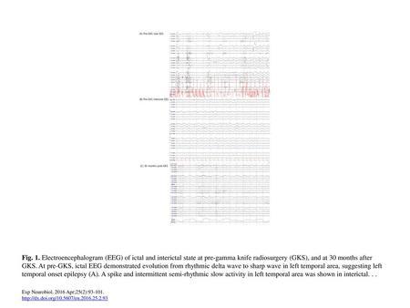 Fig. 1. Electroencephalogram (EEG) of ictal and interictal state at pre-gamma knife radiosurgery (GKS), and at 30 months after GKS. At pre-GKS, ictal EEG.