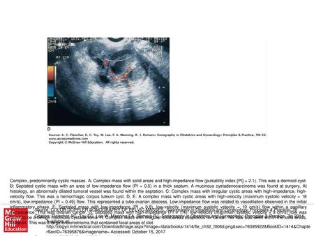 Complex, predominantly cystic masses