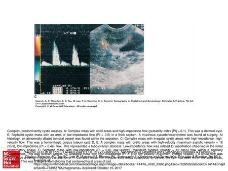 Complex, predominantly cystic masses