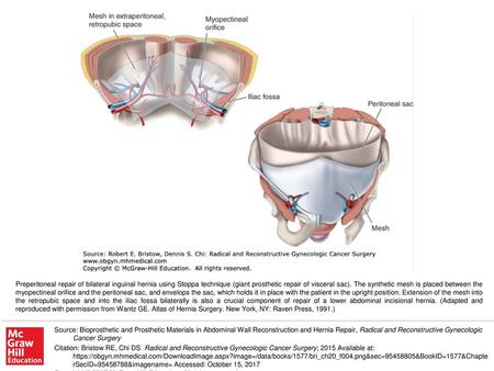 Preperitoneal repair of bilateral inguinal hernia using Stoppa technique (giant prosthetic repair of visceral sac). The synthetic mesh is placed between.