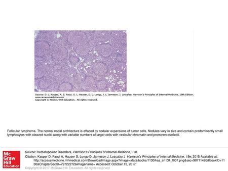 Follicular lymphoma. The normal nodal architecture is effaced by nodular expansions of tumor cells. Nodules vary in size and contain predominantly small.