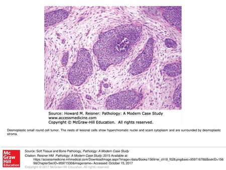 Desmoplastic small round cell tumor