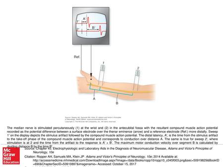 The median nerve is stimulated percutaneously (1) at the wrist and (2) in the antecubital fossa with the resultant compound muscle action potential recorded.